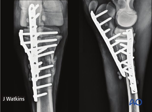 double plate fixation