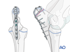 olecranon type 1a
