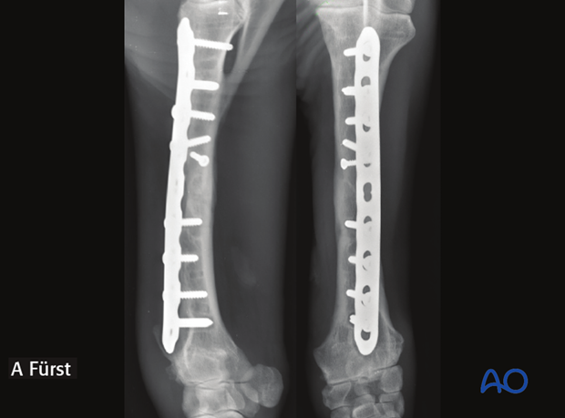 double plate fixation