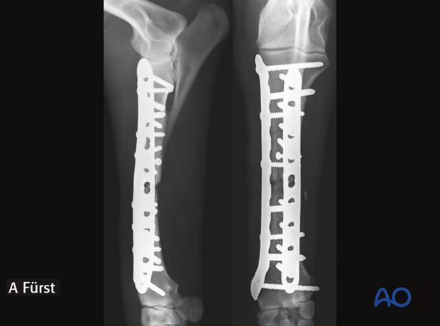 double plate fixation