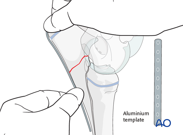 plate fixation