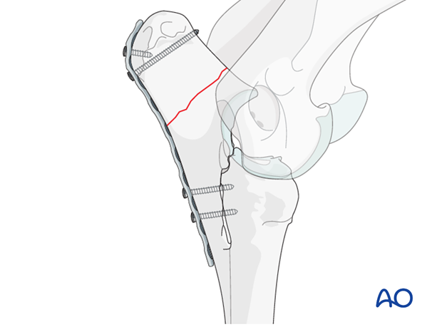 plate fixation