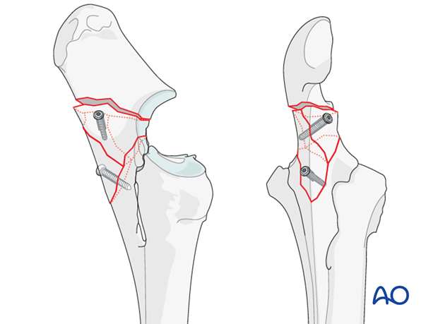 plate fixation