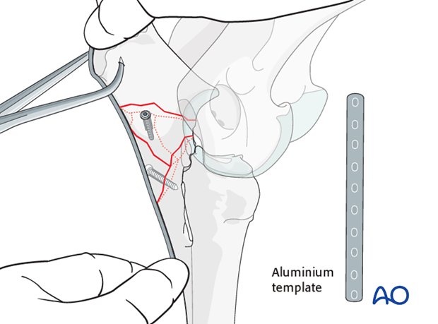 plate fixation