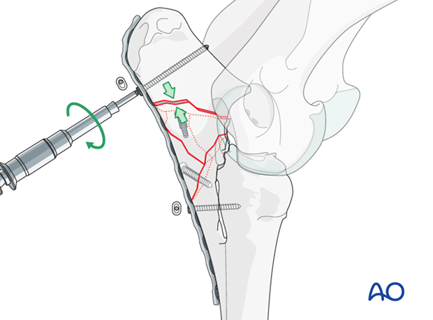 plate fixation