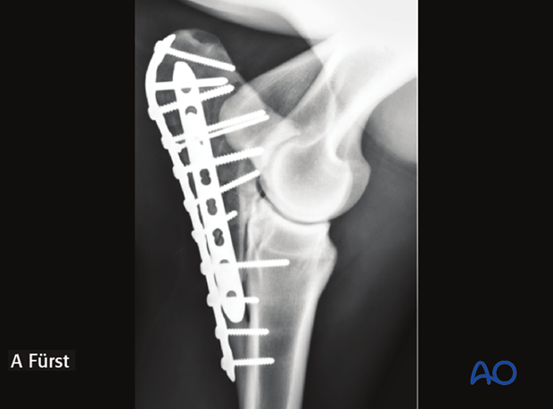 plate fixation