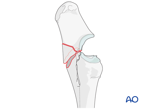 Type 5 olecranon fractures