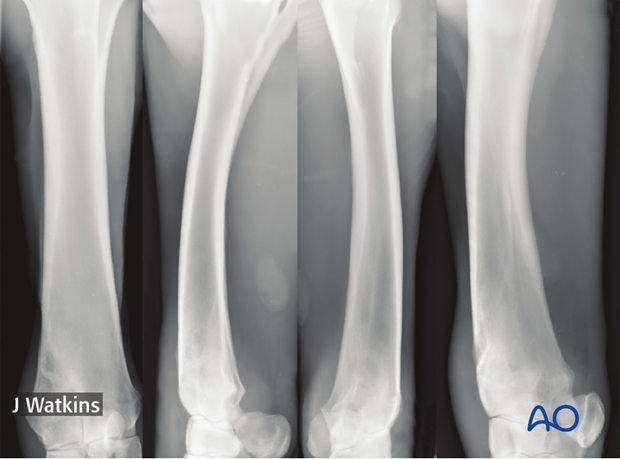 nonsurgical fracture management