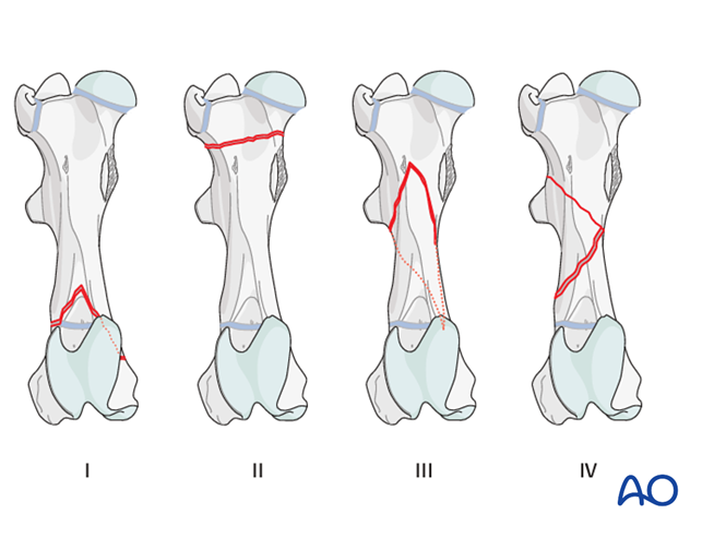 Etiology and fracture classification