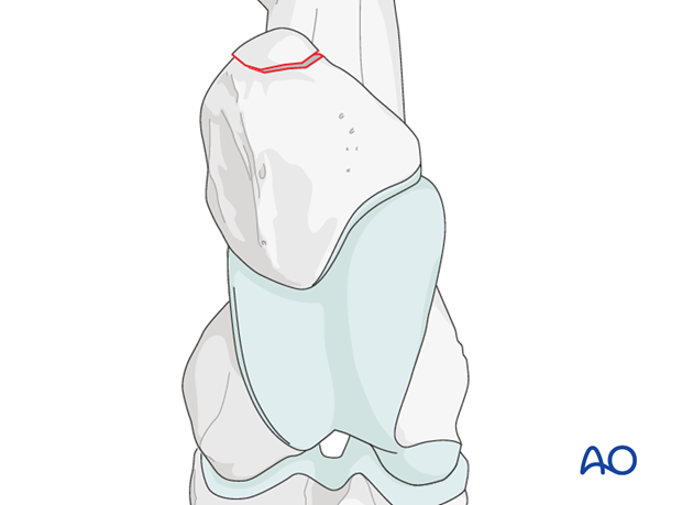 resection
