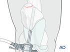 apical