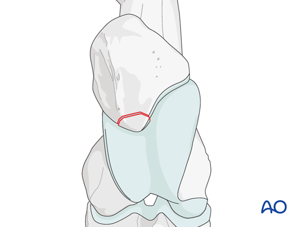 resection
