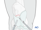 distal