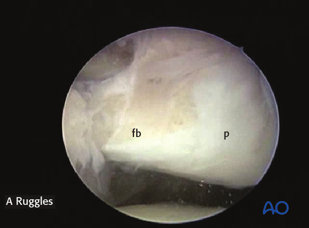resection