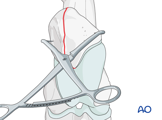 screw fixation