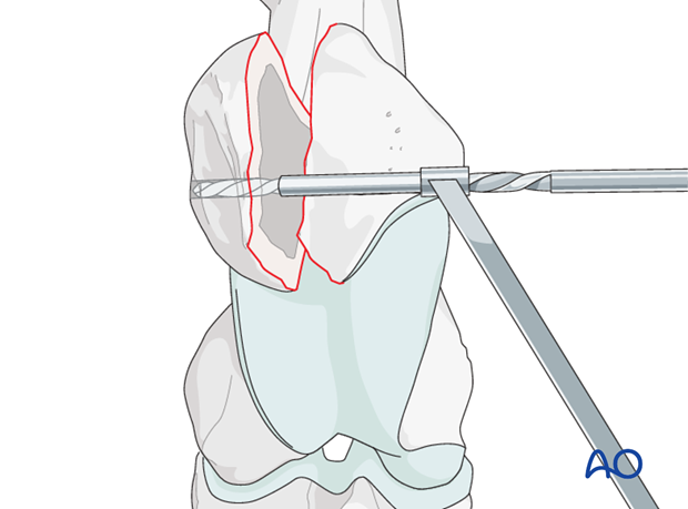 screw fixation