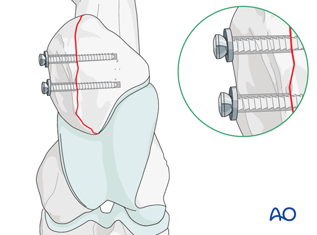 screw fixation