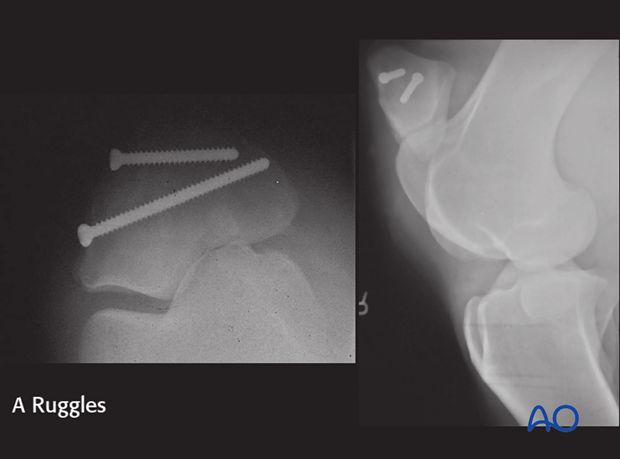 screw fixation