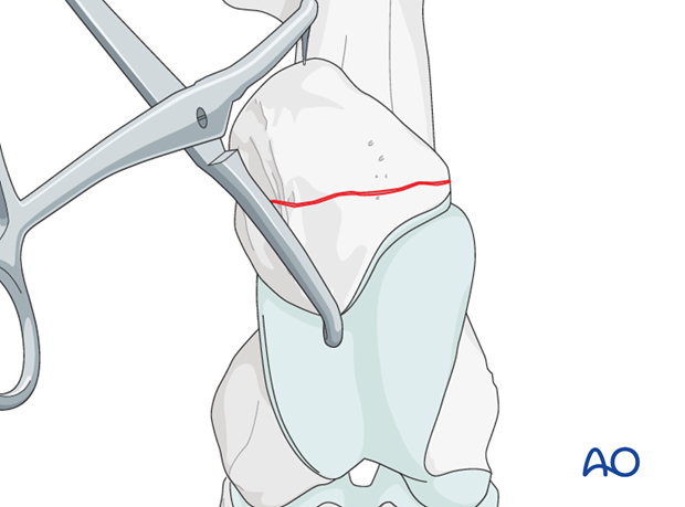 screw plate fixation