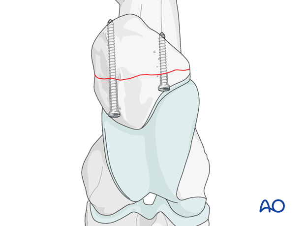 screw plate fixation