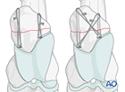 screw plate fixation