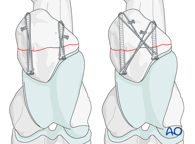 screw plate fixation
