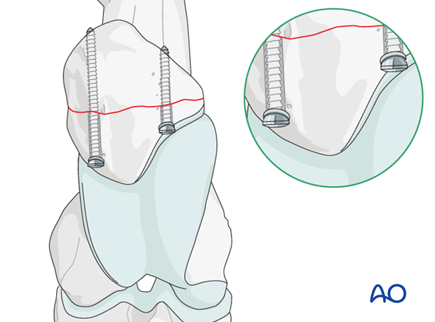 screw plate fixation