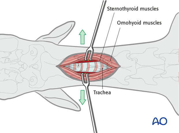 ventral midline approach to the cervical spine