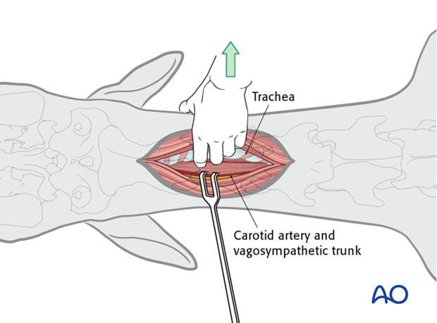ventral midline approach to the cervical spine
