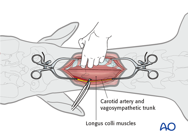 ventral midline approach to the cervical spine