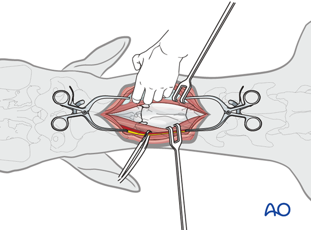 ventral midline approach to the cervical spine