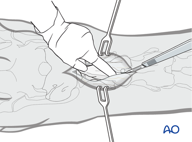 dorsal midline approach to the cervical spine