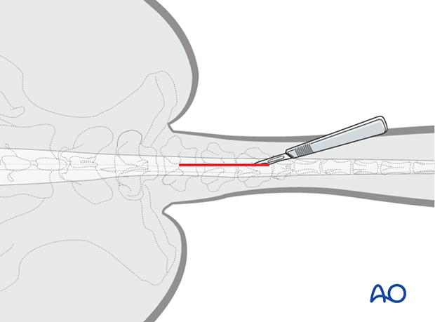 plate fixation