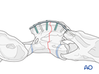 cervical c2 axial body