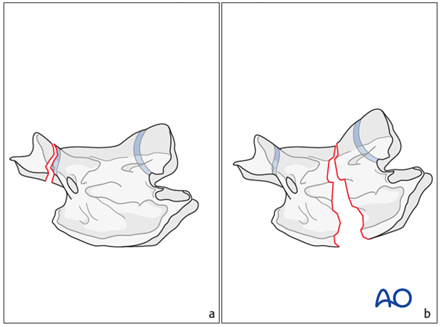 plate fixation with atlantoaxial arthrodesis