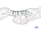 cervical c2 axial body