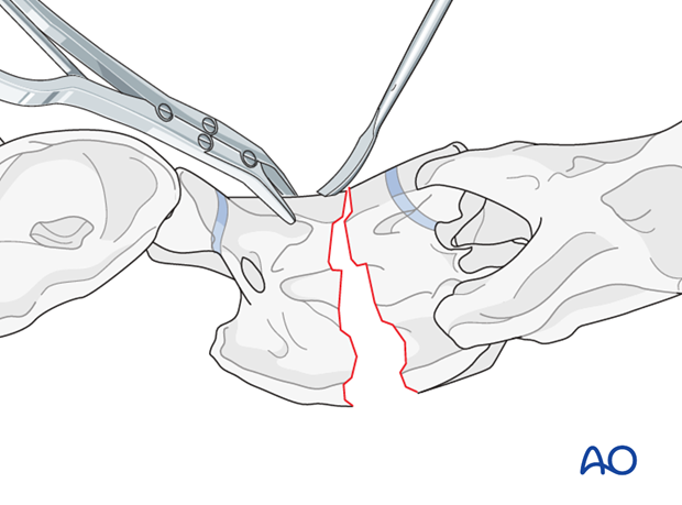 plate fixation ventrally