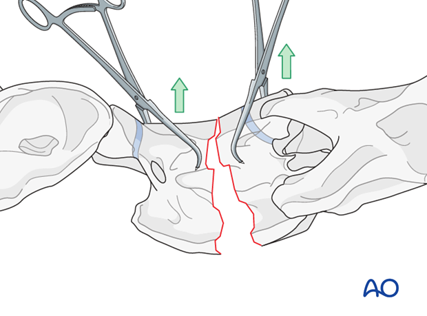 plate fixation ventrally