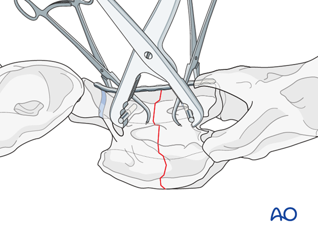 plate fixation ventrally