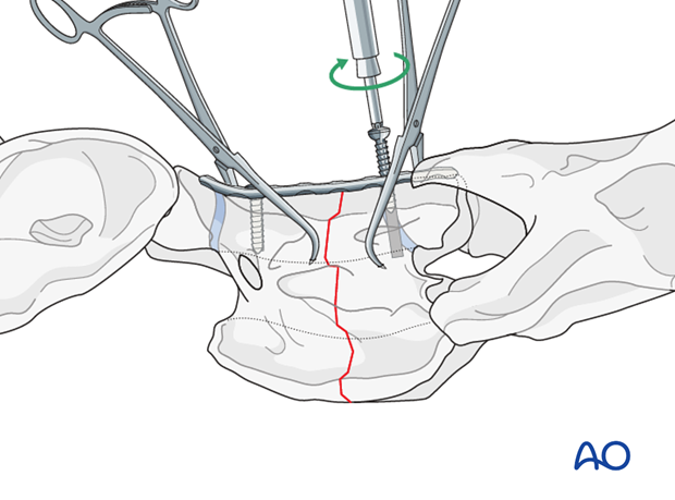 plate fixation ventrally