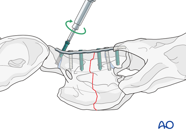 plate fixation ventrally