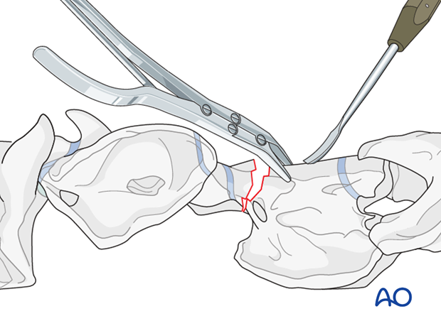 h50_P102_i060 plate fixation with atlantoaxial arthrodesis