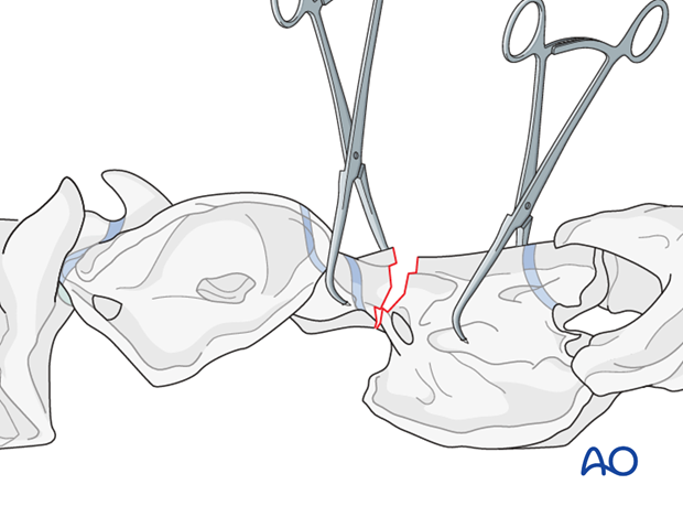 h50_P102_i080 plate fixation with atlantoaxial arthrodesis
