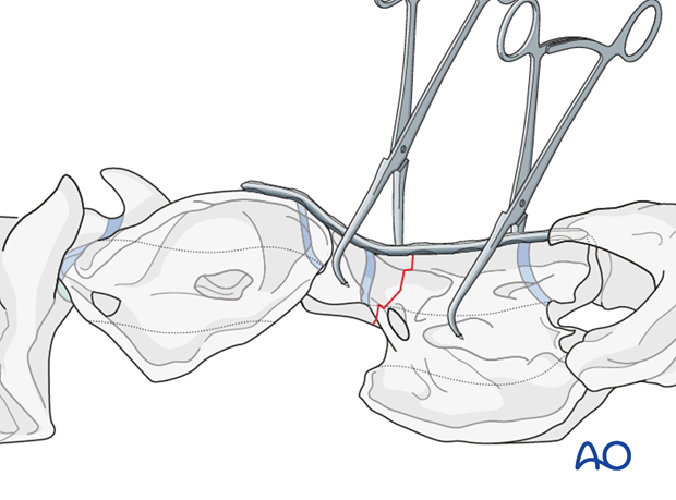 h50_P102_i140 plate fixation with atlantoaxial arthrodesis