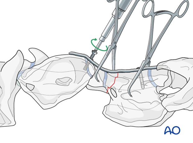 h50_P102_i160 plate fixation with atlantoaxial arthrodesis