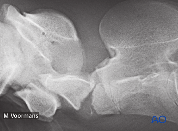 h50_P102_p01 plate fixation with atlantoaxial arthrodesis