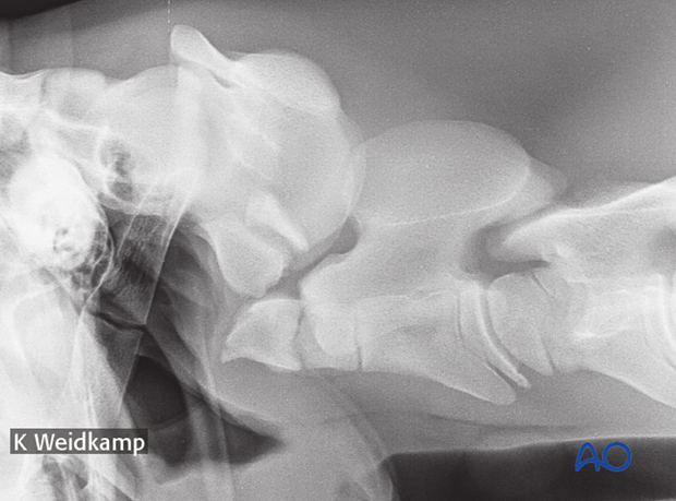 h50_P102_p10 plate fixation with atlantoaxial arthrodesis