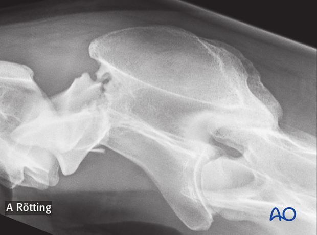 h50_P102_p11 plate fixation with atlantoaxial arthrodesis