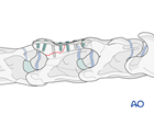 cervical c3 c7 horizontal body