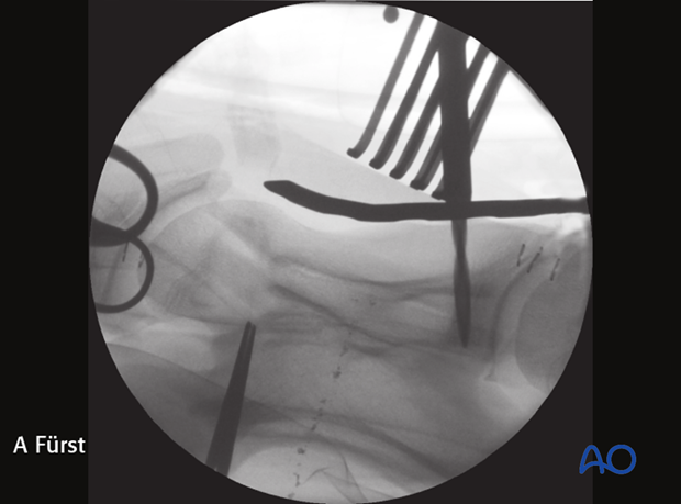 plate fixation